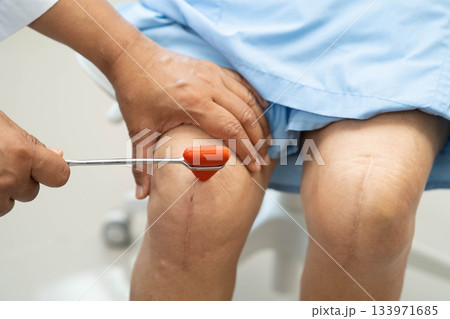 Doctor neurologist testing reflex knee with hammer and show Asian senior scars surgical total knee joint replacement. 133971685