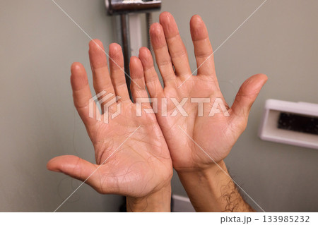 Person inspecting thinning hair in mirror, Individual observing hair loss with hand at scalp surface, Closeup view of someone assessing their hair health in bathroom Person inspecting thinning hair in mirror, Individual observing hair loss with hand at scalp surface, Closeup view of someone assessing their hair health in bathroom 133985232