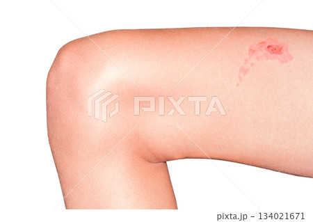 burn with blisters on a teenager leg, close-up, isolated on white background with clipping path burn with blisters on a teenager leg, close-up, isolated on white background with clipping path 134021671