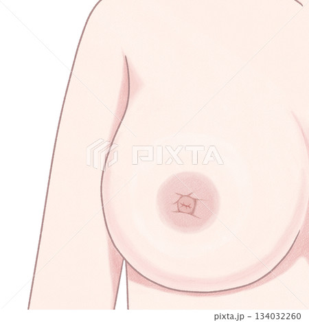 乳がんの症状　乳頭のへこみ　わかりやすい図解イラスト 134032260