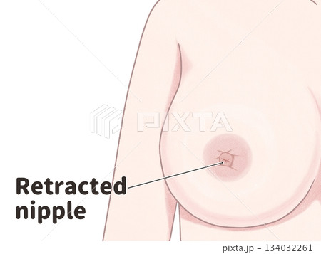乳がんの症状 乳頭のへこみ わかりやすい英語図解イラスト 乳がんの症状 乳頭のへこみ わかりやすい英語図解イラスト 134032261