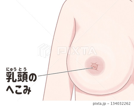 乳がんの症状　乳頭のへこみ　わかりやすい日本語図解イラスト 134032262
