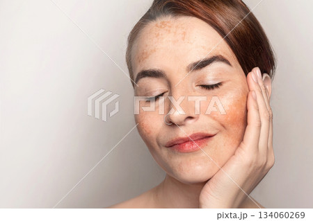 Woman shows face with pigmentation, melasma, freckles, age spots photo copy space photo 134060269