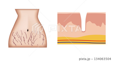 Woman abdomen showing stretch marks and detailed skin anatomy Woman abdomen showing stretch marks and detailed skin anatomy 134063504