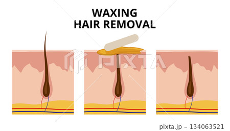 Waxing hair removal process showing before, during and after phases 134063521