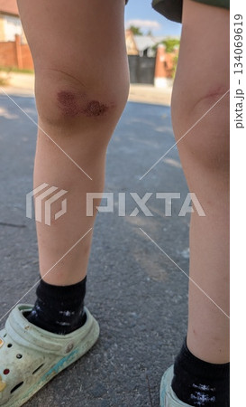 child injury detail, capturing childhood resilience through candid shot of scraped knees and sunlit 134069619