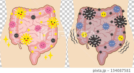の良い腸内環境と悪い腸内環境のセット　人体付き 134087581