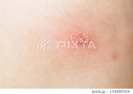 Human skin showing irritation, rash, and infection symptoms 134090504