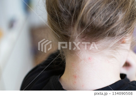 Child's neck with chickenpox showing skin rash and irritation Child's neck with chickenpox showing skin rash and irritation 134090508