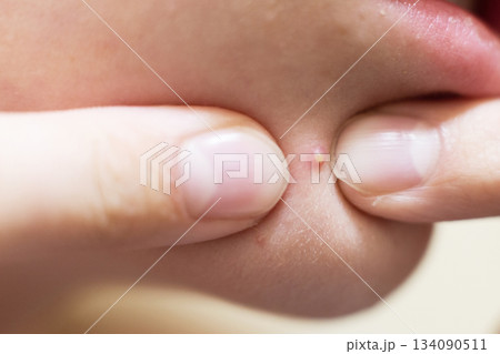 Fingers squeezing a whitehead pimple on skin Fingers squeezing a whitehead pimple on skin 134090511