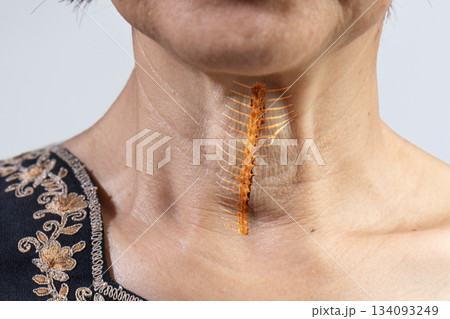 Senior woman is fish bone get stuck in throat. 134093249