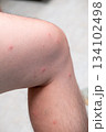 Close-up of spotted skin marks after playing in the sea during rainy season, natural outdoor effects 134102498