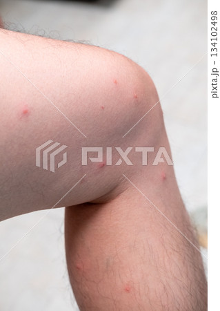 Close-up of spotted skin marks after playing in the sea during rainy season, natural outdoor effects 134102498