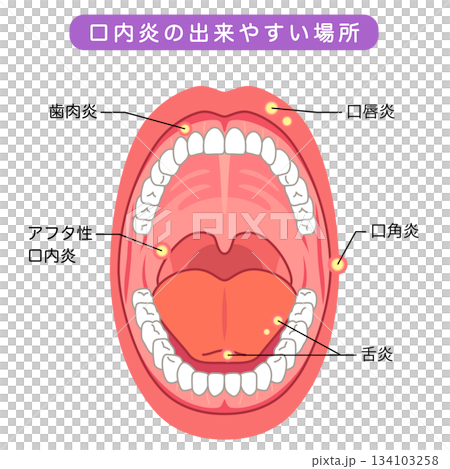 Areas where stomatitis is likely to occur: Inside the mouth, medical care Areas where stomatitis is likely to occur: Inside the mouth, medical care 134103258