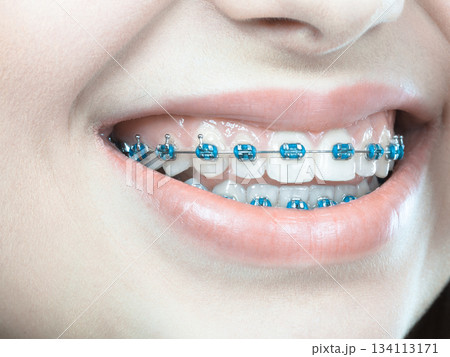 Woman showing her teeth with braces 134113171