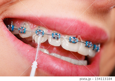 Woman brushing teeth with braces using brush 134113184