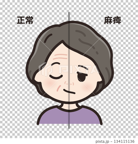 Illustration of left facial nerve paralysis_Comparison between normal and paralyzed Illustration of left facial nerve paralysis_Comparison between normal and paralyzed 134115136