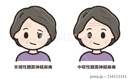 左顔面神経麻痺のイラスト_末梢性と中枢性の比較 左顔面神経麻痺のイラスト_末梢性と中枢性の比較 134115141