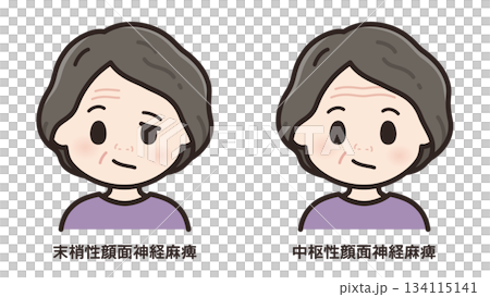 左顔面神経麻痺のイラスト_末梢性と中枢性の比較 左顔面神経麻痺のイラスト_末梢性と中枢性の比較 134115141