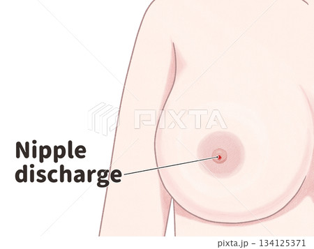 乳がんの症状　乳頭分泌　わかりやすい英語図解イラスト 134125371