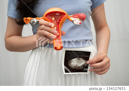 Uterus ultrasound, Asian woman holding human anatomy model. 134127651