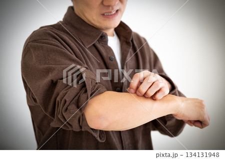 乾燥肌の痒みに苦しむミドル男性 134131948
