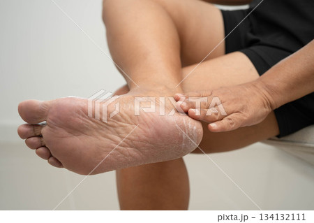 Asian woman check feet with crack and dry heel skin, Diabetic Foot. 134132111