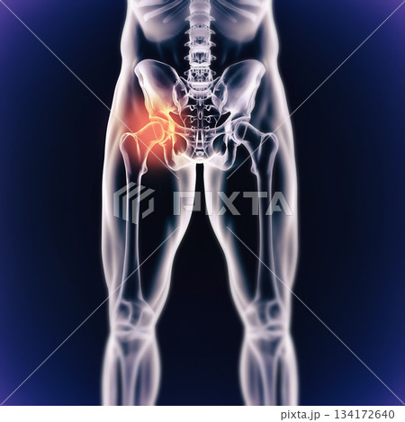 Hip pain, anatomy x ray scan of person with internal injury and cgi body structure. Diagnosis or healthcare results, technology and physiotherapist research feedback with digital skeleton on screen Hip pain, anatomy x ray scan of person with internal injury and cgi body structure. Diagnosis or healthcare results, technology and physiotherapist research feedback with digital skeleton on screen 134172640