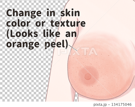 Symptoms of breast cancer: Skin changes - Easy-to-understand English illustrations Symptoms of breast cancer: Skin changes - Easy-to-understand English illustrations 134175046