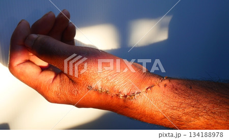 Post-Operative Wound and Stitches on Dark Skin Hand 134188978