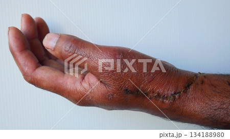 Post-Operative Wound and Stitches on Dark Skin Hand on white background Post-Operative Wound and Stitches on Dark Skin Hand on white background 134188980