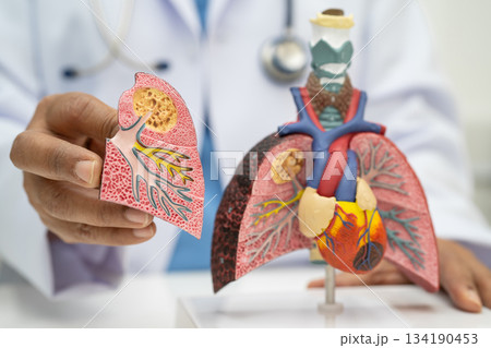 Pneumonia, lung cancer, Asian doctor holding human anatomy model for study diagnosis and treatment in hospital. 134190453