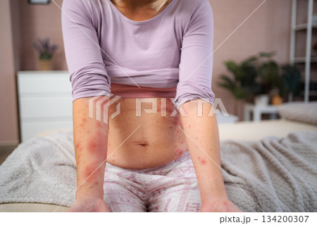 Woman showing red rash on arms and stomach Woman showing red rash on arms and stomach 134200307
