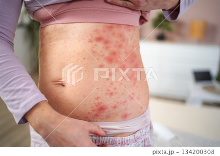 Woman showing red rash on stomach and side concept 134200308