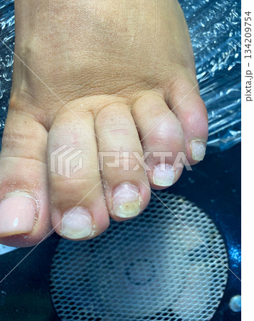 Closeup of Damaged Toenails 134209754