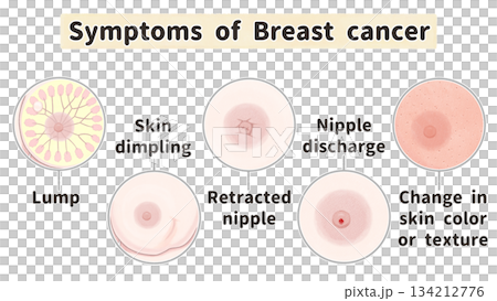 乳癌的症狀和外觀變化:簡明易懂的英文插圖 乳癌的症狀和外觀變化:簡明易懂的英文插圖 134212776