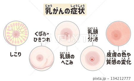 乳がんの症状と見た目の変化 わかりやすい日本語図解イラスト 乳がんの症状と見た目の変化 わかりやすい日本語図解イラスト 134212777