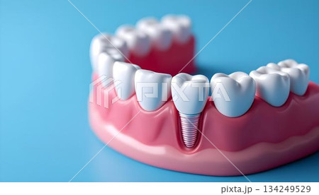 Image of a dental implant with a tooth on a blue background, highlighting dental care and health 134249529