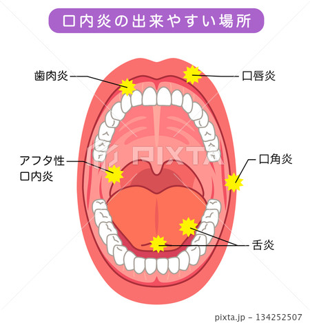 口内炎の出来やすい場所　口の中　医療 134252507