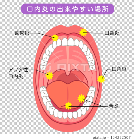 口内炎の出来やすい場所　口の中　医療 134252507