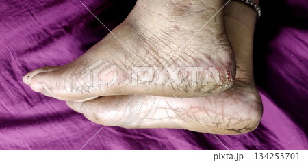 Close-Up of Cracked Heels and Bare Feet 134253701
