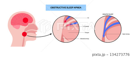 Obstructive sleep apnea 134273776