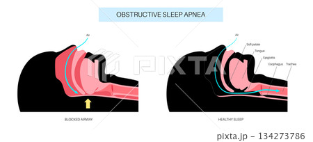 Obstructive sleep apnea Obstructive sleep apnea 134273786