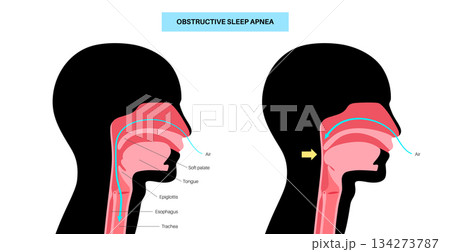 Obstructive sleep apnea 134273787
