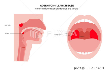 Adenotonsillar disease poster 134273791