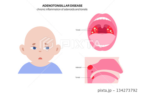 Adenotonsillar disease poster 134273792