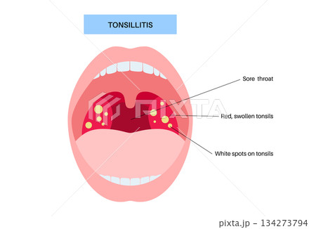 Tonsillitis medical poster 134273794