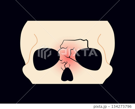 Nasal fracture poster 134273796