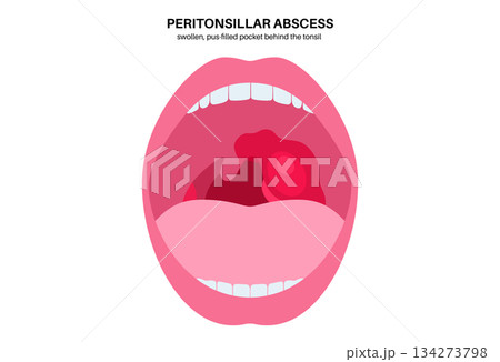 Peritonsillar abscess poster 134273798