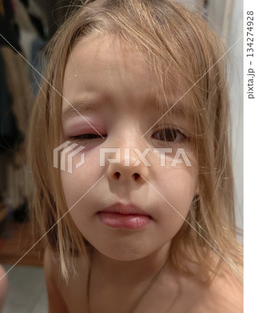 The child has an eyelid infection, causing his left eye to become swollen, red, and partially closed. Eyelid infection is a common eye condition that can impact a child's health. 134274928